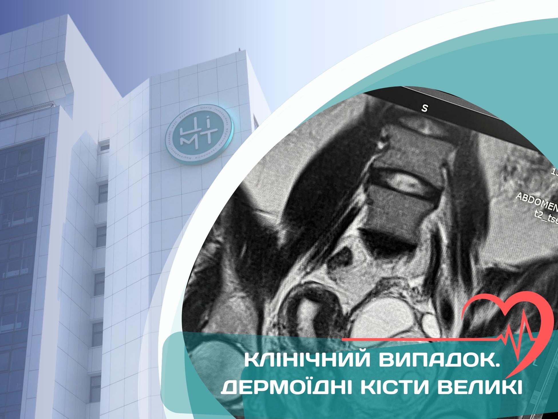Клінічний випадок. Дермоїдні кісти великі